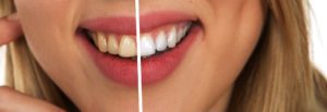 Czy istnieją domowe sposoby na wybielanie zębów?